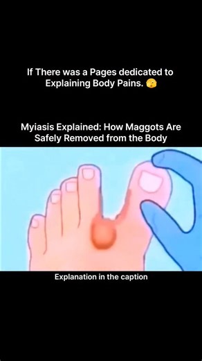 Explaining Biology on Instagram: "Myiasis is a parasitic condition caused when certain flies lay their eggs on human skin or open wounds. Once the eggs hatch, the larvae—commonly known as maggots—begin feeding on living or dead tissue. This may sound disturbing, but it’s a fascinating example of survival biology in action. The larvae breathe through a small opening in the skin, which is why blocking oxygen is often used during treatment. Doctors typically remove them by applying substances like 