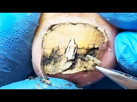 Careful excision of bilateral bad nails and deep cleaning【Pedicure King】