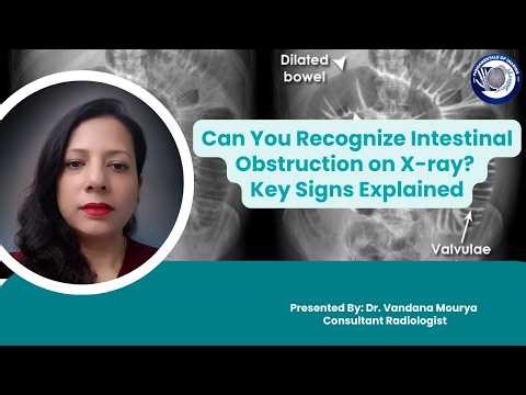 Can You Recognize Intestinal Obstruction on X ray? Key Signs Explained