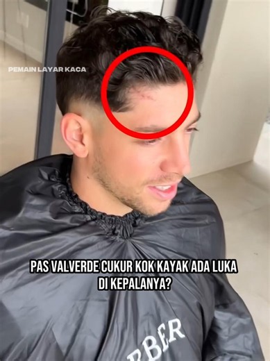 Ada luka di kepala Valverde 👀😱