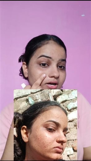 Best cream for acne.#acnejourney #skinhealing #indianskincare #youtubeshorts