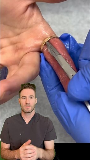 Dr. Joe, M.D. | To remove a ring stuck on a finger using the string method, you need a thin string or dental floss. First, slip one end of the string under... | Instagram