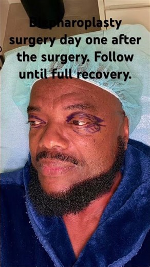 Blepharoplasty Surgery