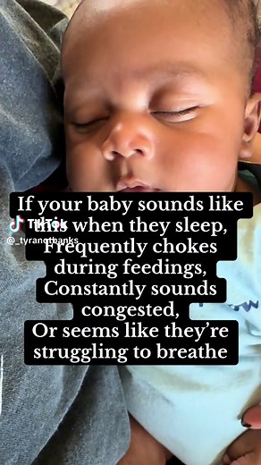 Laryngomalacia is a voice box disorder common in newborns. The tissues above their voice box soften and fall over their airway. This causes stridor (noisy or high-pitched breathing). Laryngomalacia usually goes away on its own by the time your baby is 1 to 2 years old. #boymom #infant #momtok #larygomalacia #momsoftiktok #fyp #symptoms