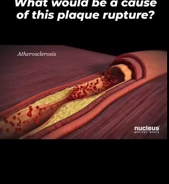 52K views · 41 reactions | Plaque rupture in coronary artery disease...