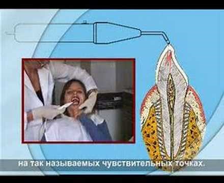 Pulp tester (Electrodontodiagnostics)