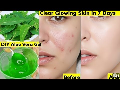 Acne, Pimples, Pigmentation & Forehead Bumps | I Tried This Face Cream Gel