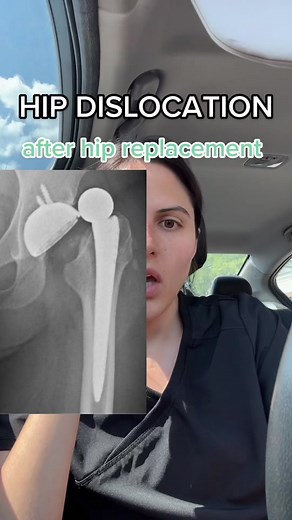 Hip Dislocation: Causes, Recovery, and Physical Therapy Tips