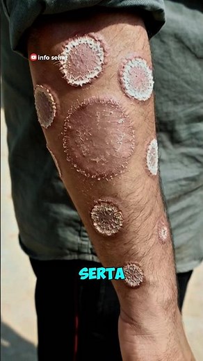 Kurap Bukan Alergi! Ini Ciri, Penyebab, dan Obatnya | Penyakit Kulit