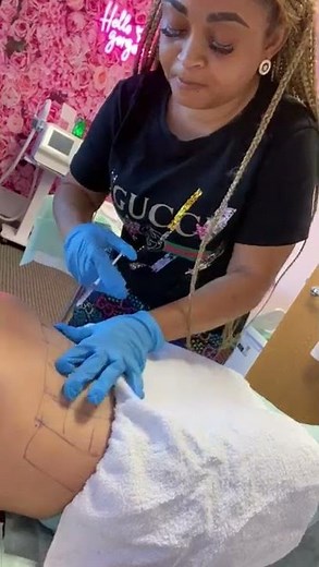 mesotherapy fat dissolver injection with Lipo Lab PPC solution destroys fat.