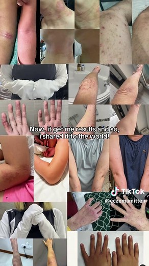 How's eczema??? Its the worst! #eczemaawareness #eczema #eczemaflareup #eczematok