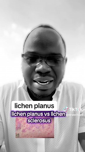 Lichen Planus vs Lichen Sclerosus: Symptoms & Treatment