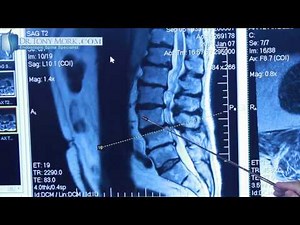 Degenerative Spondylolisthesis by Dr. Tony Mork