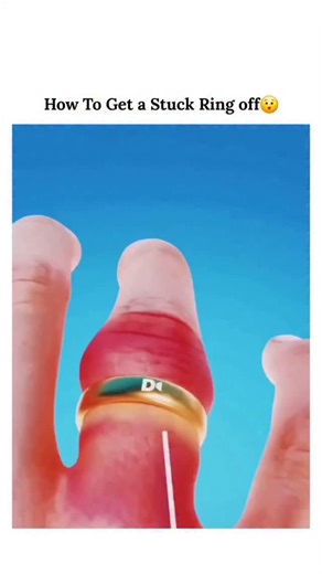 UNIVERSE | SCIENCE | TECHNOLOGY on Instagram: "the string method for safely removing a stuck ring from a swollen finger. This technique works by compressing the soft tissue, allowing the ring to slide over the knuckle without causing further injury. Steps for the String Method Thread the string: Pass one end of a thin, strong string (like dental floss or ribbon) under the ring toward the palm side of the hand. Wrap the finger: Starting from the top edge of the ring, snugly wrap the remaining lon