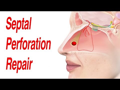 Septal Perforation Repair