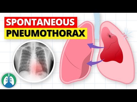 Spontaneous Pneumothorax | Lung Collapse Causes and Prevention