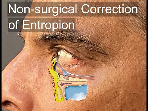 Non-Surgical Correction of Involutional Entropion
