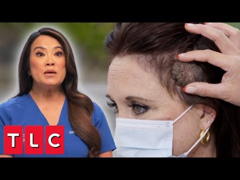 Dr. Lee Tackles a Wart That Won’t Stop Growing! | Dr. Pimple Popper