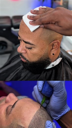 La Micropigmentación capilar es la solución perfecta para la caída del cabello! Visítanos en NY. #smp #micropigmentacion #smpnewyork #scalpmicropigmentation