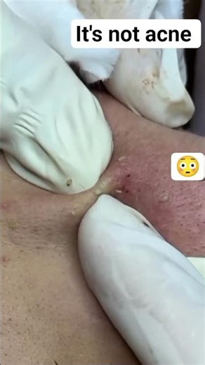 This Is NOT Acne 😳 | Inflamed Sebaceous Cyst Explained#shortvideo