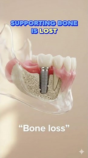 What Causes Dental Implants to Loosen?