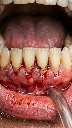 Removing Years of Rock Hard Tartar Instantly