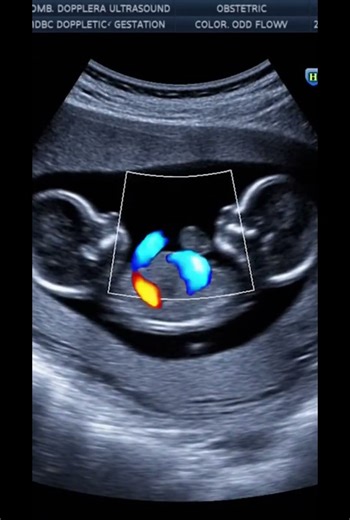 👁️ 4D Ultrasound: The Triplets Seeing Each Other!#baby #Shorts #Viral #Triplets