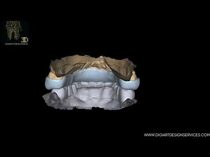 Bite Splints for the Upper Mouth Using Exocad