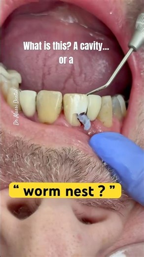 “Worm Nest in My Tooth?!”“Big Hole in Tooth… What’s Crawling Inside?”