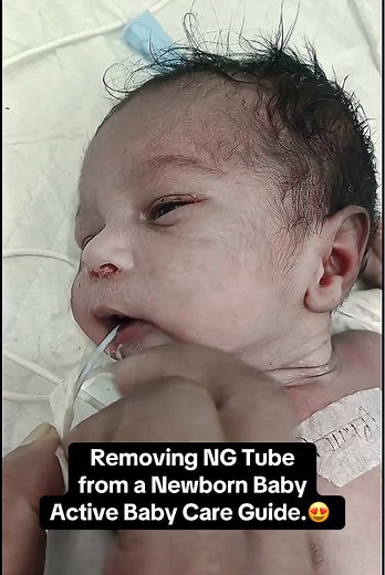 Removing NG Tube from a Newborn Baby: A Care Guide