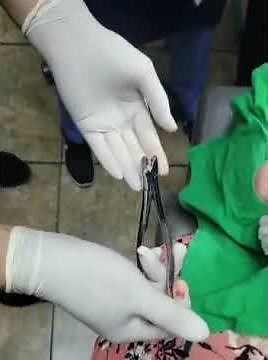 teaching extraction of 3rd molar w forcep