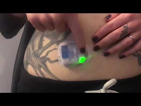 How to remove Neulasta after injection (the day after chemotherapy).