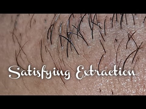 Hair Extraction |Beard| satisfying & relaxing part 1