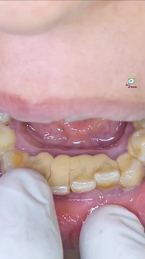 𝙉𝙤 𝙫𝙞𝙤𝙡𝙖𝙩𝙞𝙤𝙣 𝙩𝙞𝙠𝙩𝙤𝙠 𝙙𝙤𝙣'𝙩 𝙧𝙚𝙢𝙤𝙫𝙚 𝙫𝙞𝙙𝙚𝙤, 𝘿𝙤𝙣'𝙩 𝙗𝙚 𝙖𝙛𝙧𝙖𝙞𝙙 𝙩𝙤 𝙙𝙤 𝙨𝙘𝙖𝙡𝙞𝙣𝙜 𝙩𝙝𝙞𝙨 𝙞𝙨 𝙫𝙚𝙧𝙮 𝙝𝙚𝙡𝙥𝙛𝙪𝙡 𝙛𝙤𝙧 𝙮𝙤𝙪𝙧 𝙙𝙚𝙣𝙩𝙖𝙡 𝙝𝙚𝙖𝙡𝙩𝙝 𝘾𝙖𝙡𝙘𝙪𝙡𝙪𝙨 𝙍𝙚𝙢𝙤𝙫𝙖𝙡 𝙬𝙞𝙩𝙝 𝙐𝙡𝙩𝙧𝙖𝙨𝙤𝙣𝙞𝙘 𝙎𝙘𝙖𝙡𝙞𝙣𝙜🦷🧑‍⚕️🪥 #dr_of_smile #i_love_dentistry❤ #foryou #foryoupage #video #viral #tiktok #trending #account #grow #dentist #viralvideo #viraltiktok #unfrezzmyaccount #tiktokpakistan