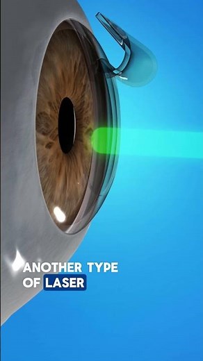 How Does LASIK Work?