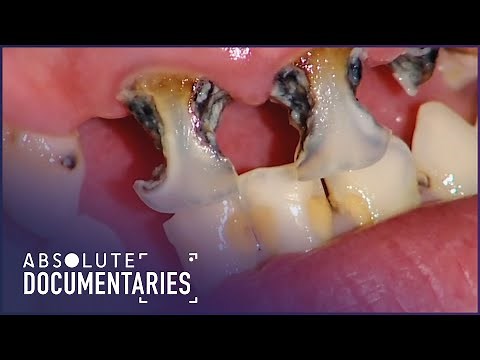 Throwing up Every Day Has Eroded All My Teeth: Britain's Worst Teeth