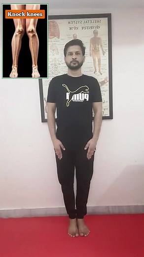 101K views · 2.6K reactions | Knock knee Correction Exercise.. | Dr.Nishant Gautam | Facebook