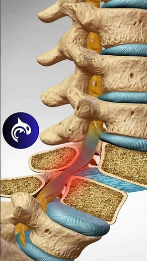 Spondylolisthesis of the Spine | 4K 3D Animation