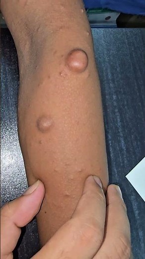 Neurofibroma