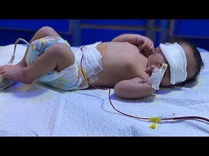 Exchange Transfusion in Newborn | Step by Step Procedure Explained