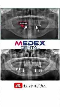 Medex Dental | Multi-Unit Mandibular Implant Rehabilitation | Botticelli Implant #dentalimplant