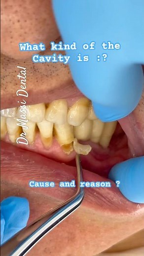 What’s that cavity called ?
