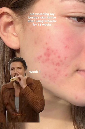 Proactiv Before and After Skincare Transformation