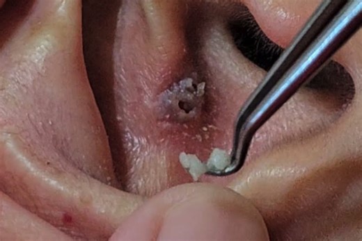 Huge Blackhead Removed from Ear