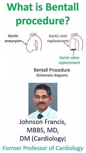 What is Bentall procedure?