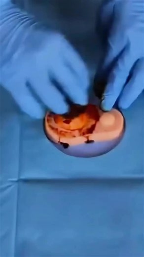 Vetventures | Abscess Drainage 😷 #medicalinstagram #veterinariansofinstagram #doctorsofinstagram #surgeonsofinstagram #nursesofinstagram | Instagram