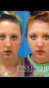 Tear Trough Filler: Before and After