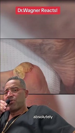 INCISION & DRAINAGE OF HUGE HEEL ABSCESS🤯#shorts