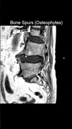 Bone Spurs (Osteophytes) Sagittal T1 #MRI #Radiology #Shorts