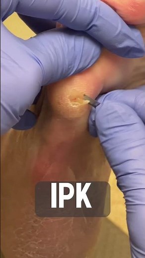 Shaving a callus and clogged sweat gland on foot! #shorts #callus